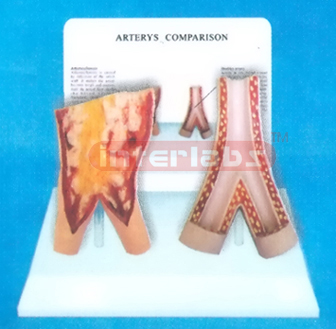 DESK-TYPE, ARTERY MODEL FOR COMPARISION DEMONSTRATING HEALTHMAN THAN SMOKING  MAN WITH DESCRIPTION PLATE